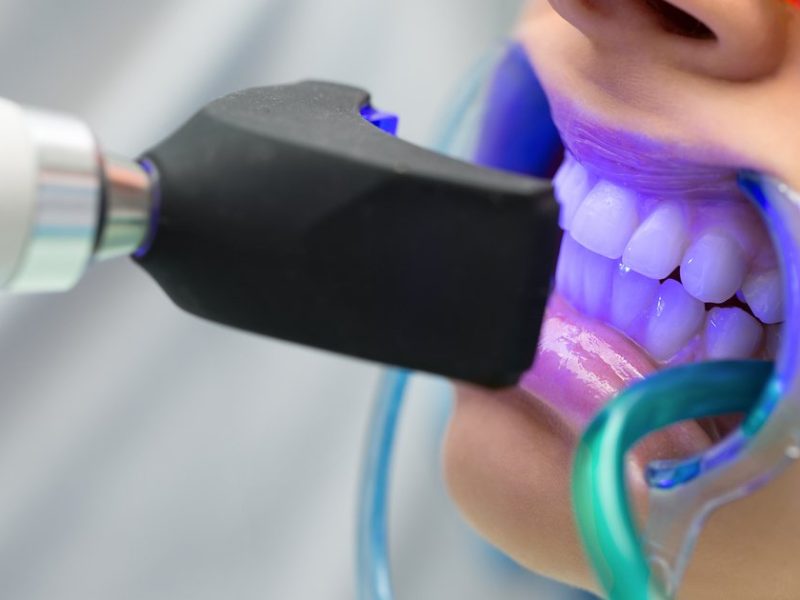 que-es-blanqueamiento-dental-1200x630.original